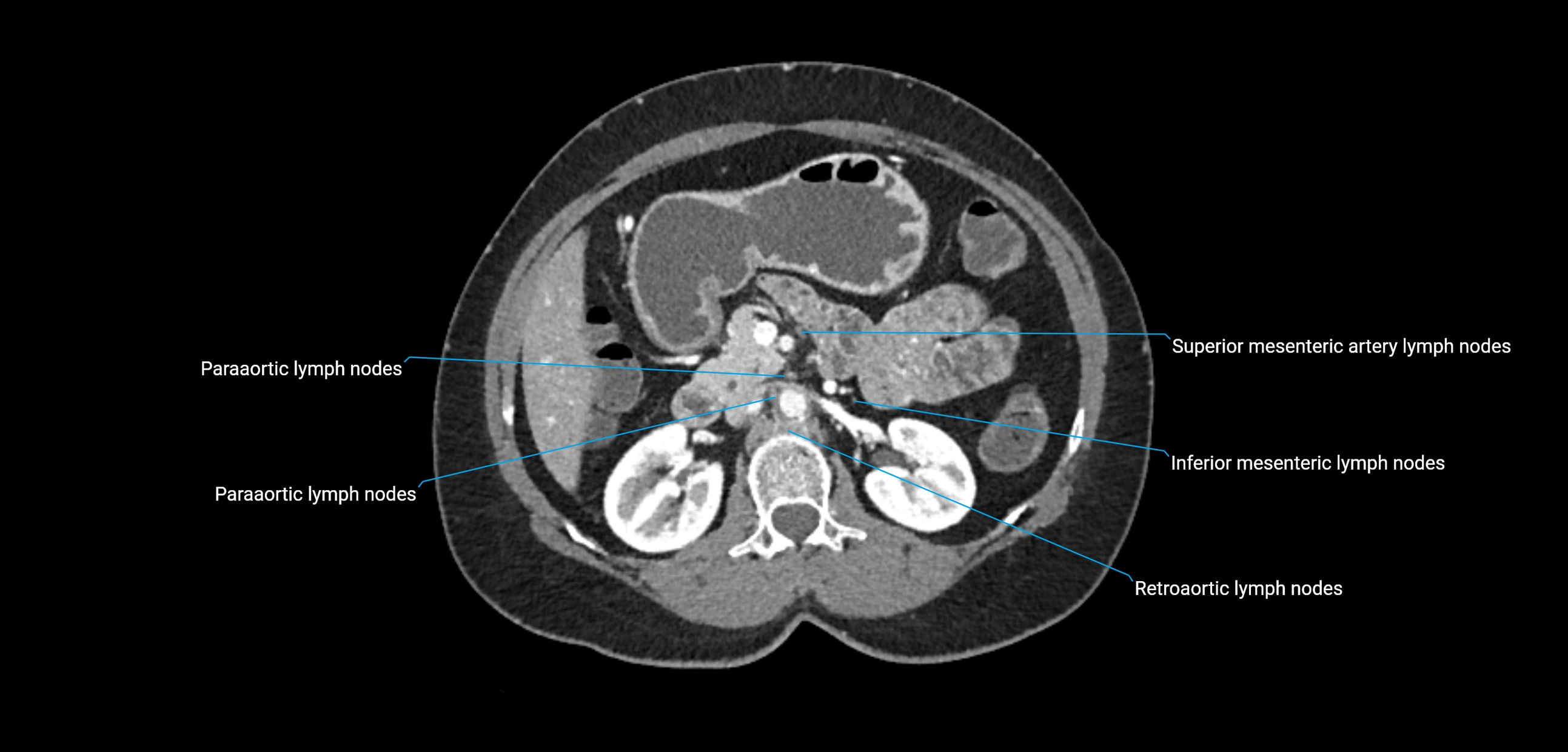 CT ct abdominal lymph nodes  axial cross sectional anatomy  enchanced radiology image -img-00002-00175.webp